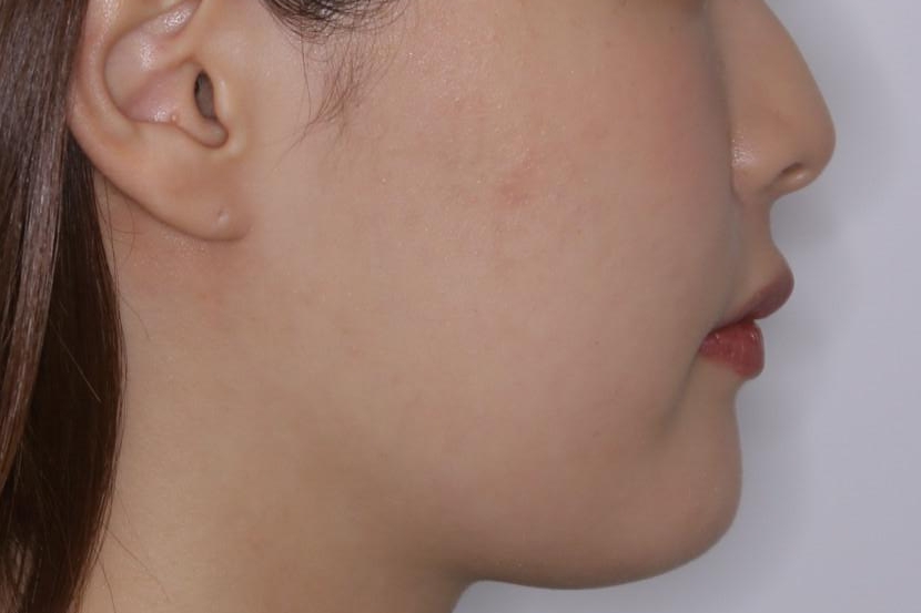 がたつきが強いガチャ歯。埋伏歯抜歯+矯正。すごいところに犬歯が埋まっていたのを抜いてワイヤー矯正治療の治療後(顔貌)