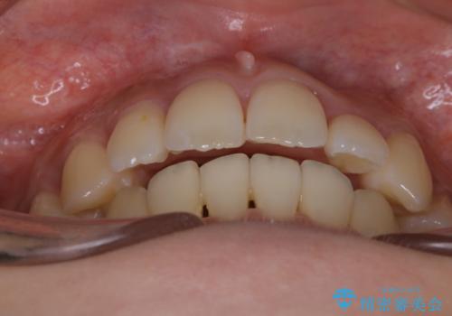 がたつきが強いガチャ歯。埋伏歯抜歯+矯正。すごいところに犬歯が埋まっていたのを抜いてワイヤー矯正治療の治療後