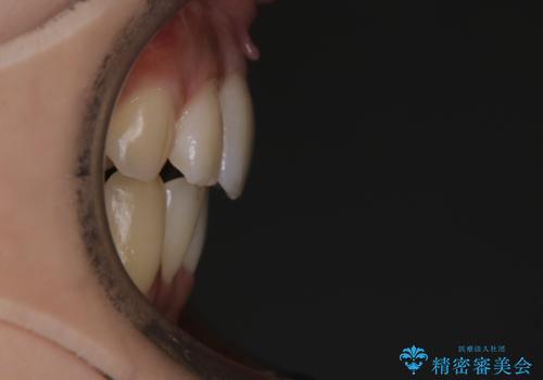 がたつきが強いガチャ歯。埋伏歯抜歯+矯正。すごいところに犬歯が埋まっていたのを抜いてワイヤー矯正治療の治療後