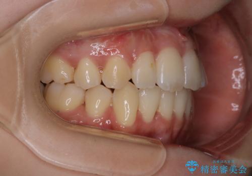 がたつきが強いガチャ歯。埋伏歯抜歯+矯正。すごいところに犬歯が埋まっていたのを抜いてワイヤー矯正治療の治療後