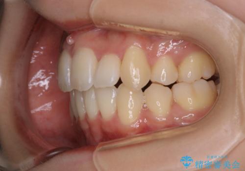 がたつきが強いガチャ歯。埋伏歯抜歯+矯正。すごいところに犬歯が埋まっていたのを抜いてワイヤー矯正治療の治療後