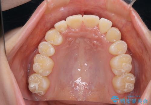 がたつきが強いガチャ歯。埋伏歯抜歯+矯正。すごいところに犬歯が埋まっていたのを抜いてワイヤー矯正治療の治療後