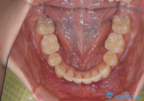 がたつきが強いガチャ歯。埋伏歯抜歯+矯正。すごいところに犬歯が埋まっていたのを抜いてワイヤー矯正治療の治療後