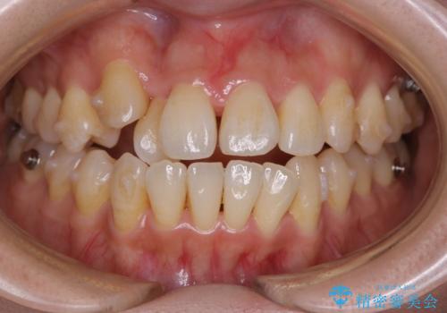 本来は外科ケース:インビザラインで前歯の重度がたつきとオープンバイトの改善の治療中