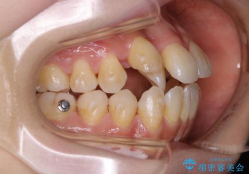 本来は外科ケース:インビザラインで前歯の重度がたつきとオープンバイトの改善の治療中