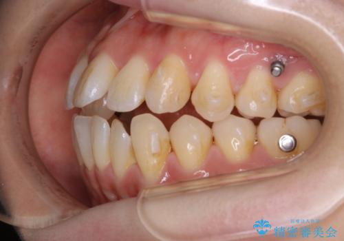 本来は外科ケース:インビザラインで前歯の重度がたつきとオープンバイトの改善の治療中