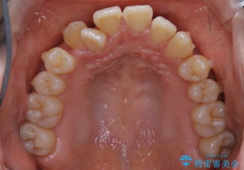 本来は外科ケース:インビザラインで前歯の重度がたつきとオープンバイトの改善の治療中