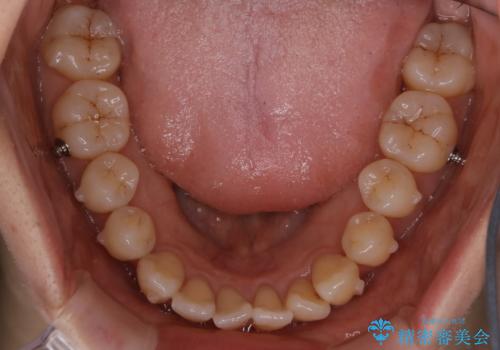 本来は外科ケース:インビザラインで前歯の重度がたつきとオープンバイトの改善の治療中
