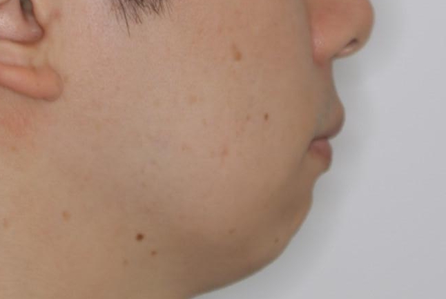 がたつき、口ゴボ(出っ歯)、真ん中のずれを抜歯矯正治療で治す。ワイヤー矯正治療の治療後(顔貌)