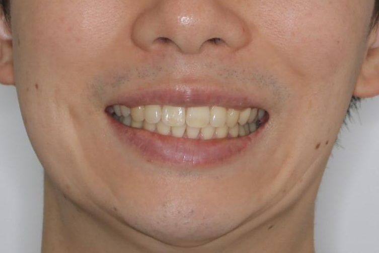 がたつき、口ゴボ(出っ歯)、真ん中のずれを抜歯矯正治療で治す。ワイヤー矯正治療の治療後(顔貌)