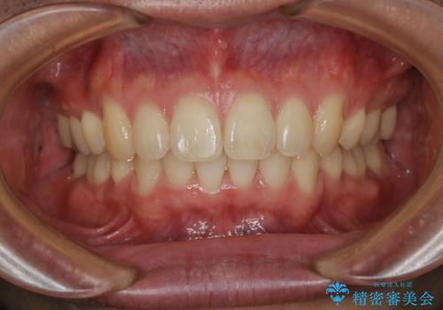 がたつき、口ゴボ(出っ歯)、真ん中のずれを抜歯矯正治療で治す。<span class=