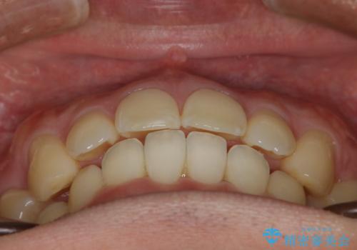 がたつき、口ゴボ(出っ歯)、真ん中のずれを抜歯矯正治療で治す。ワイヤー矯正治療の治療後