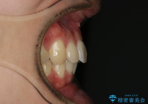 がたつき、口ゴボ(出っ歯)、真ん中のずれを抜歯矯正治療で治す。ワイヤー矯正治療の治療後