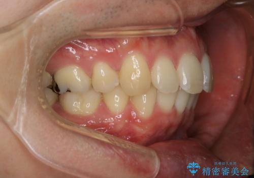 がたつき、口ゴボ(出っ歯)、真ん中のずれを抜歯矯正治療で治す。ワイヤー矯正治療の治療後