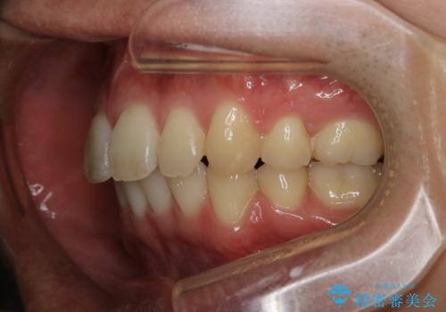 がたつき、口ゴボ(出っ歯)、真ん中のずれを抜歯矯正治療で治す。ワイヤー矯正治療の治療後