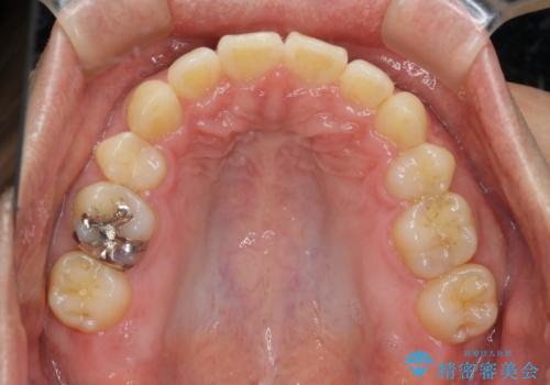 がたつき、口ゴボ(出っ歯)、真ん中のずれを抜歯矯正治療で治す。ワイヤー矯正治療の治療後