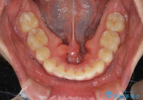 がたつき、口ゴボ(出っ歯)、真ん中のずれを抜歯矯正治療で治す。ワイヤー矯正治療の治療後