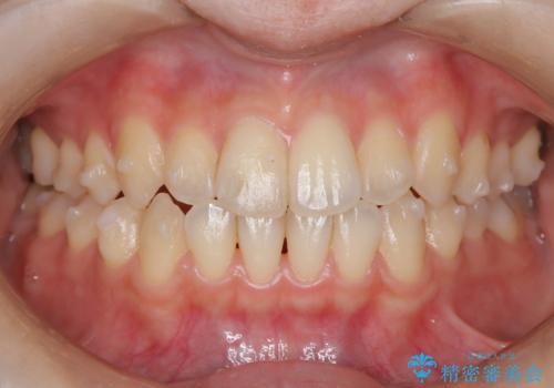 前歯のガタつき、下顎の前突感を治したい インビザライン矯正例の治療中