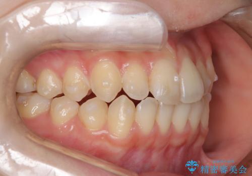 前歯のガタつき、下顎の前突感を治したい　インビザライン矯正例の治療中