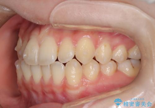 前歯のガタつき、下顎の前突感を治したい インビザライン矯正例の治療中