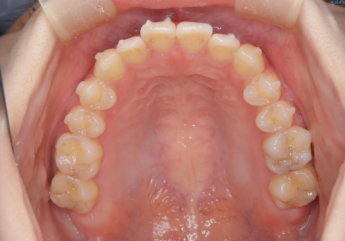 前歯のガタつき、下顎の前突感を治したい インビザライン矯正例の治療中