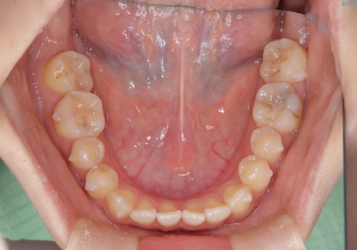 前歯のガタつき、下顎の前突感を治したい インビザライン矯正例の治療中