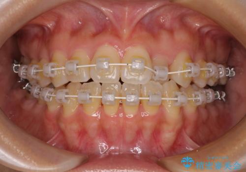 クロスバイトの前歯を改善 ワイヤー装置で楽々矯正治療の治療中