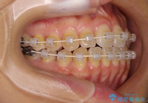 クロスバイトの前歯を改善　ワイヤー装置で楽々矯正治療の治療中