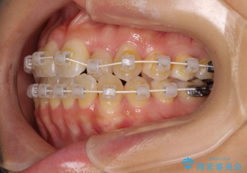 クロスバイトの前歯を改善 ワイヤー装置で楽々矯正治療の治療中