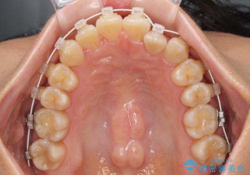 クロスバイトの前歯を改善 ワイヤー装置で楽々矯正治療の治療中