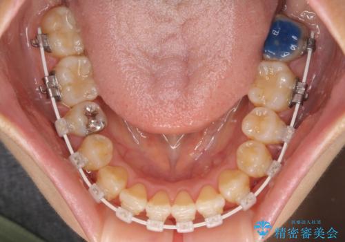 クロスバイトの前歯を改善　ワイヤー装置で楽々矯正治療の治療中