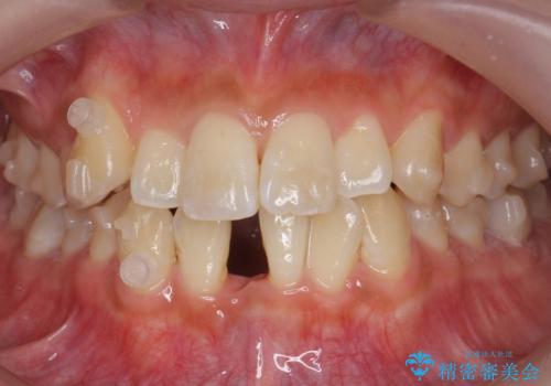 八重歯をインビザラインで 抜歯矯正の治療中