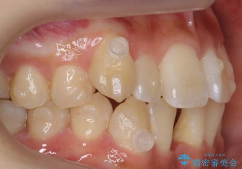 八重歯　インビザラインで抜歯矯正　ただし1本のみの抜歯で済みますの治療中