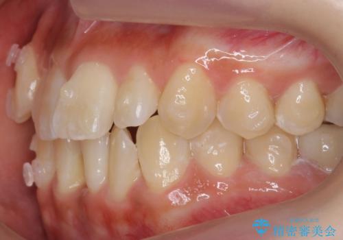 八重歯をインビザラインで　抜歯矯正の治療中