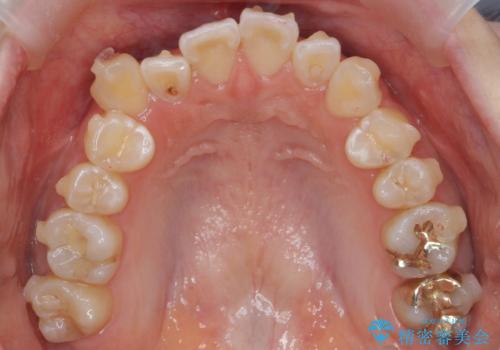 八重歯をインビザラインで 抜歯矯正の治療中