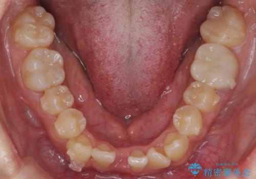 八重歯 インビザラインで抜歯矯正 ただし1本のみの抜歯で済みますの治療中