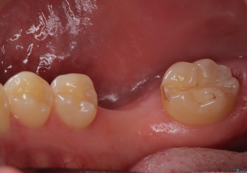 失ったままの臼歯 インプラントによる治療の治療前