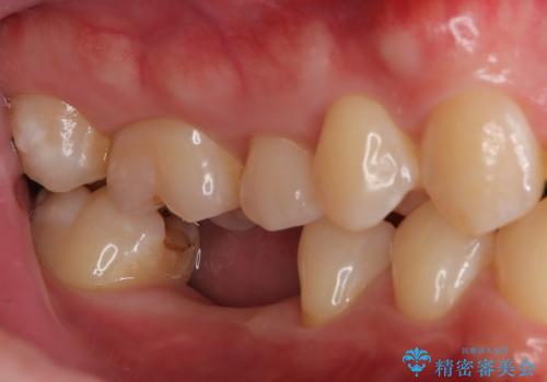 失ったままの臼歯 インプラントによる治療の治療前