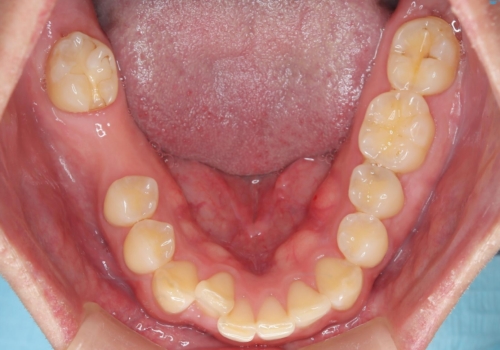 失ったままの臼歯 インプラントによる治療の治療前