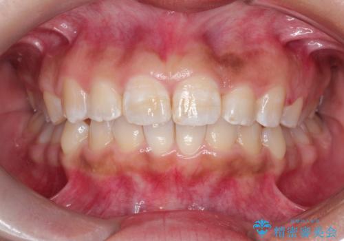 マウスピース矯正で前歯のガタツキを改善! ワイヤー矯正併用でかみ合わせもしっかり治しますの治療中