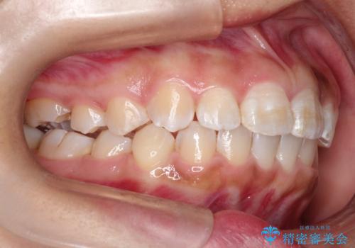 マウスピース矯正で前歯のガタツキを改善! ワイヤー矯正併用でかみ合わせもしっかり治しますの治療中