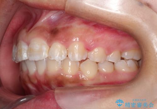 マウスピース矯正で前歯のガタツキを改善! ワイヤー矯正併用でかみ合わせもしっかり治しますの治療中