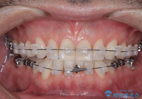 定期健診で歯並びを相談 セラミックブラケットでのワイヤー矯正例の治療中