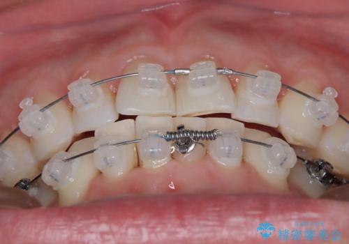 定期健診で歯並びを相談 セラミックブラケットでのワイヤー矯正例の治療中