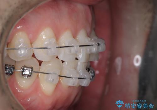 定期健診で歯並びを相談 セラミックブラケットでのワイヤー矯正例の治療中
