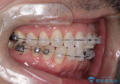 定期健診で歯並びを相談 セラミックブラケットでのワイヤー矯正例の治療中