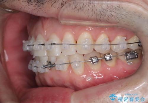 定期健診で歯並びを相談 セラミックブラケットでのワイヤー矯正例の治療中