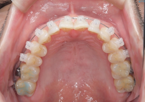 定期健診で歯並びを相談　セラミックブラケットでのワイヤー矯正例の治療中
