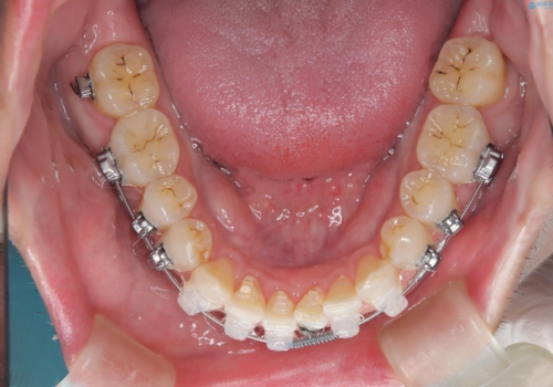 定期健診で歯並びを相談　セラミックブラケットでのワイヤー矯正例の治療中