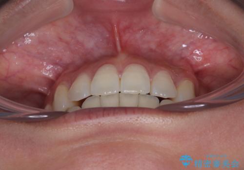 前に飛び出した上顎前歯をスッキリと引っ込める ワイヤー装置での矯正治療の治療後